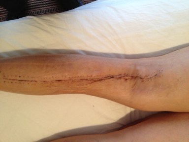 the much improved leg!