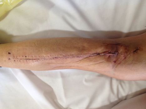 My not-so-lovely leg post clip removal