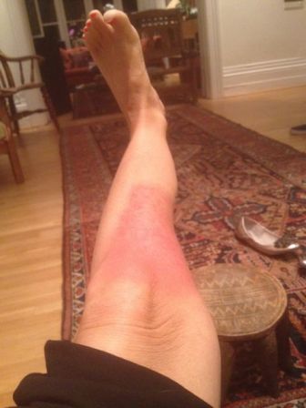 My leg showing the burn