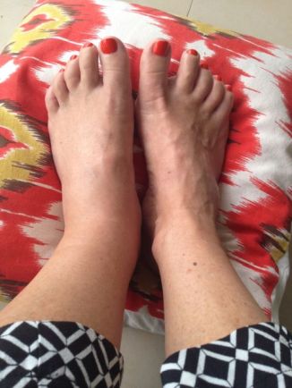 Swollen foot, showing off new pedicure (it's much worse now for the record!)